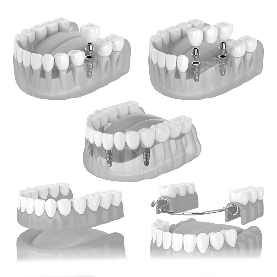 Abbildung verschiedener Lösungen von Zahnersatz auf Implantaten